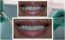 Porcelain Crowns & Veneers