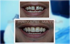 E-Max Porcelain Veneers