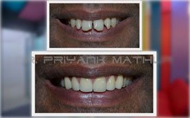 Smile Correction