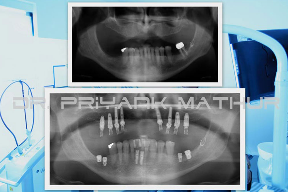 Dental Implants in India