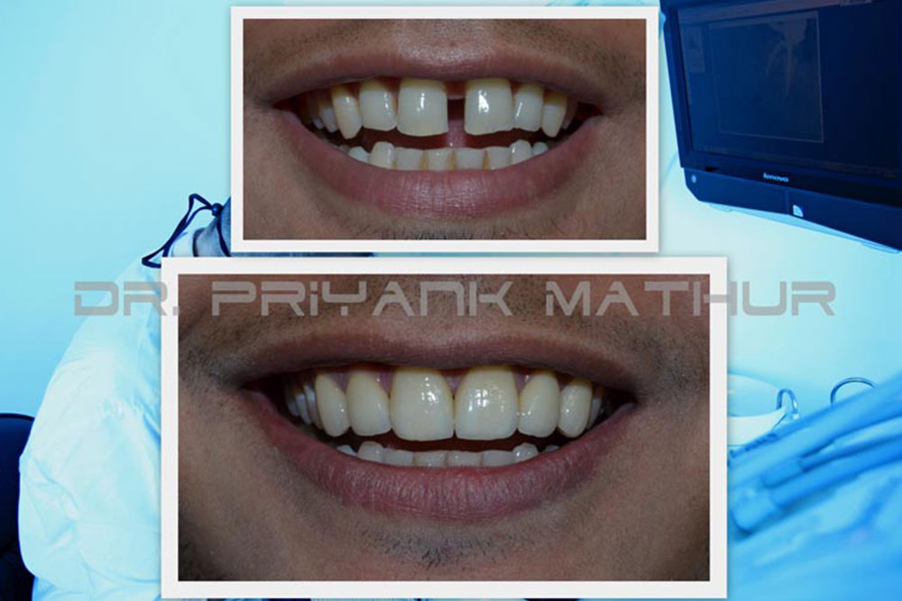 E-Max Porcelain Veneers