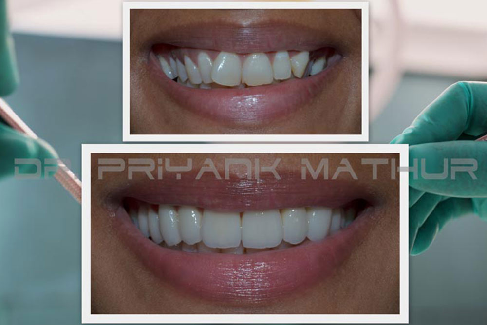 Emax Porcelain Crowns & Veneers in India