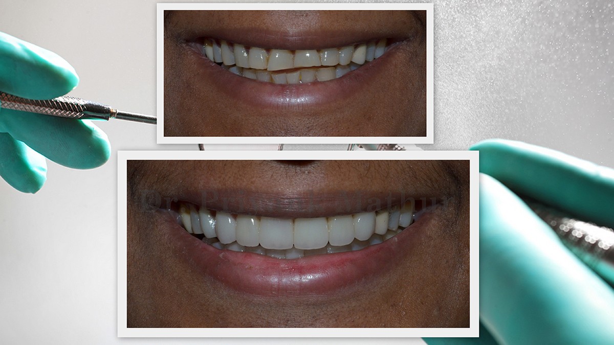 E-Max Porcelain Veneers