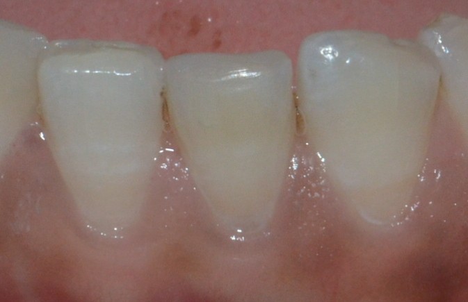 Internally bleached tooth