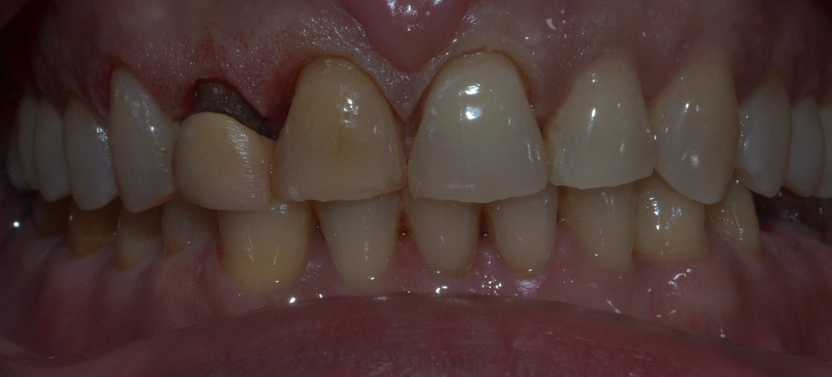 After laser gum correction