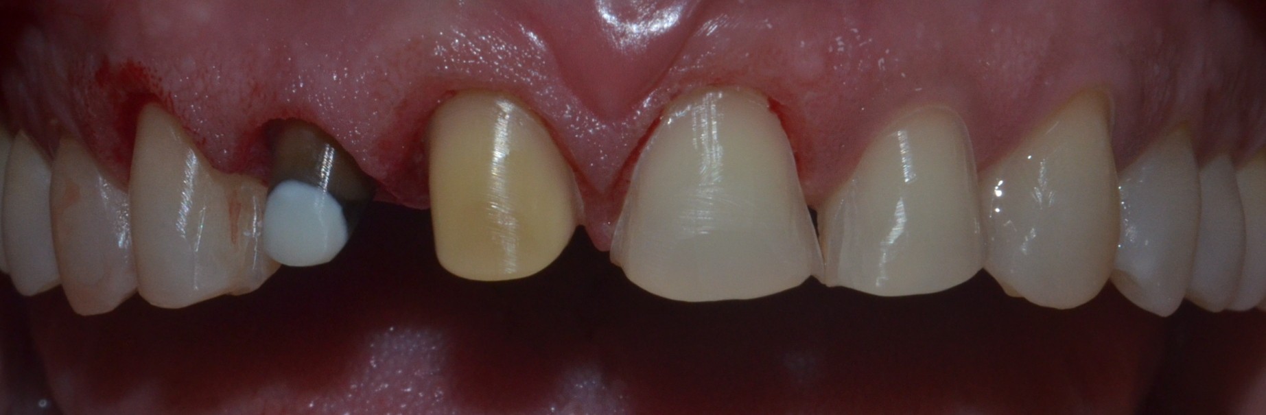 After teeth preparation