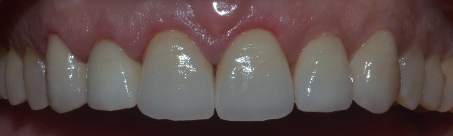 upper teeth emax crowns & veneers