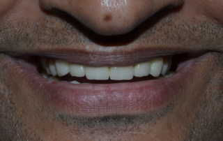 full mouth rehabilitation in Pune, India