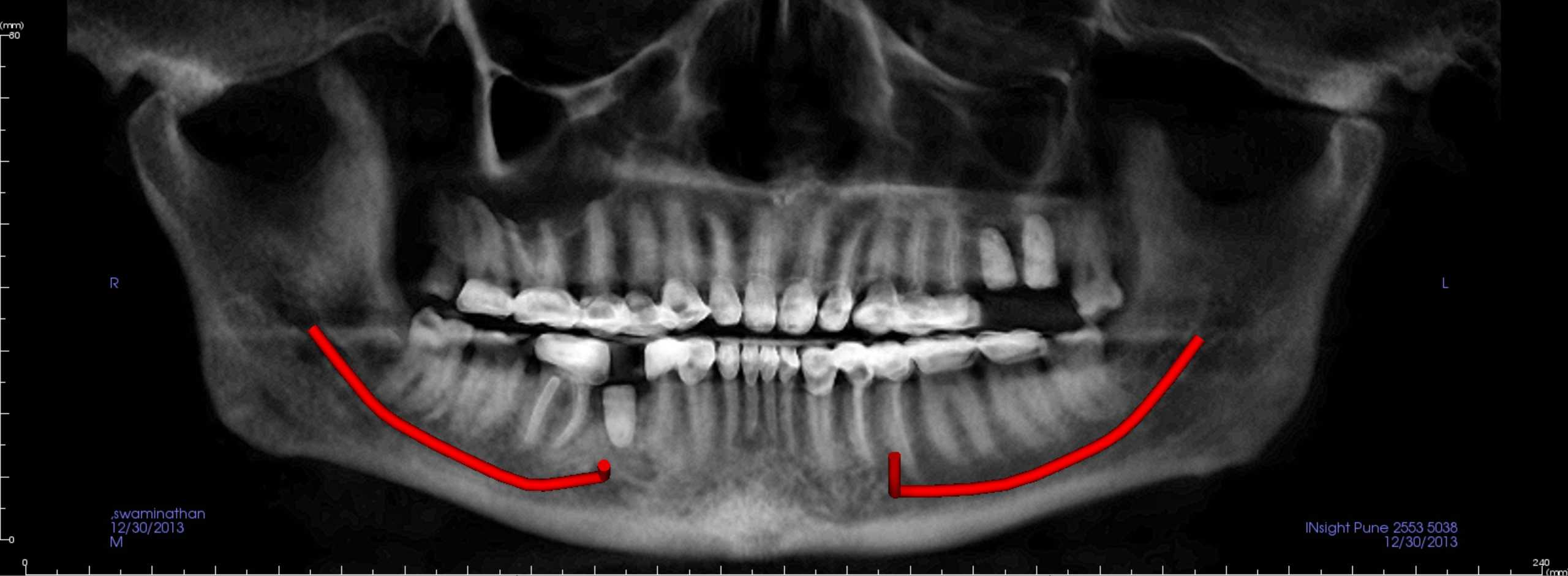 OPG of full mouth rehab